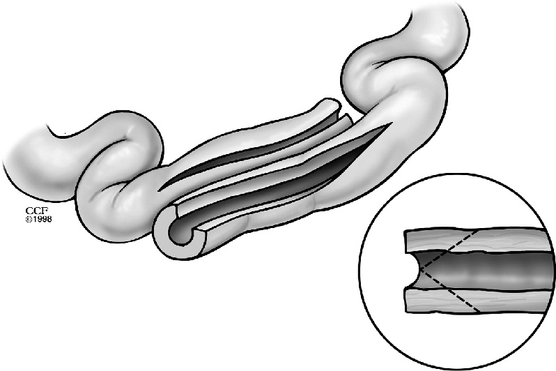Diagram of the Michelassi side-to-side isoperistaltic strictureplasty for long strictures