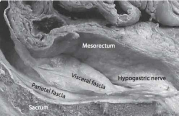 Surgical photograph showing the posterior dissection plane during total mesorectal excision