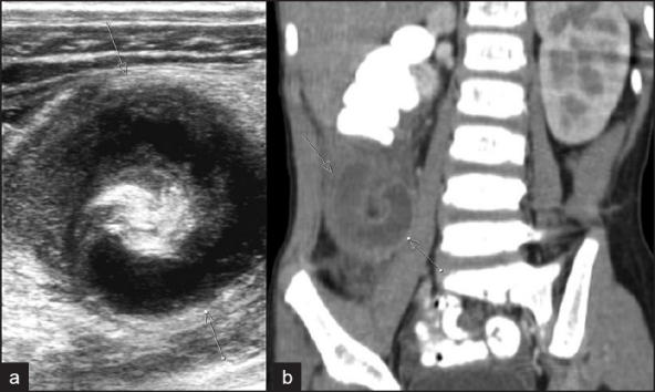 CT scan of acute appendicitis showing dilated fluid-filled appendix with surrounding fat stranding