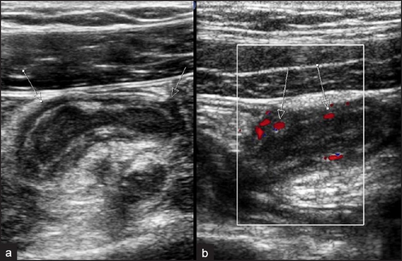 Ultrasound images of acute appendicitis showing non-compressible tubular structure with hyperemic wall on Doppler