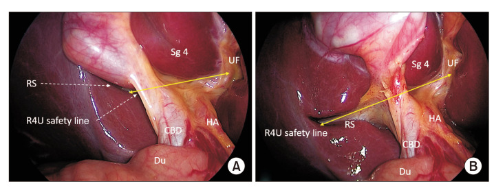 Anatomical diagram of the hepatocystic triangle showing the biliary system, cystic duct, common hepatic duct, and key surgical landmarks