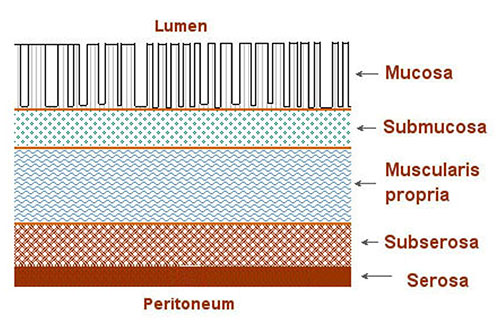 Diagram showing the layers of the bowel wall including mucosa, submucosa, muscularis propria, subserosa, and serosa relevant to TNM staging