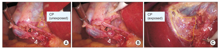 Intraoperative images demonstrating Calot triangle dissection and cystic duct-artery delineation during laparoscopic cholecystectomy