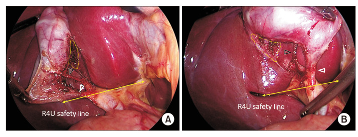 Anterior and posterior doublet views demonstrating the achieved critical view of safety during laparoscopic cholecystectomy