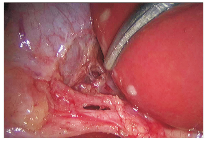 Comparison showing inadequate dissection without cystic plate exposure versus properly achieved critical view of safety
