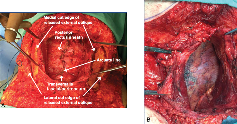 Intraoperative photographs showing midline fascial closure and retromuscular mesh placement during ventral hernia repair