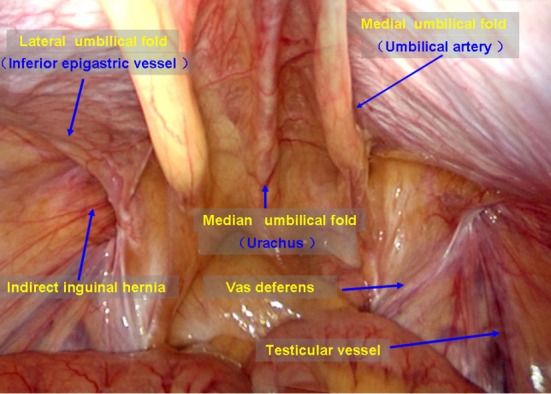 Laparoscopic view of bilateral inguinal anatomy showing the internal inguinal ring, vas deferens, gonadal vessels, and inferior epigastric vessels