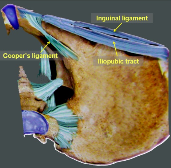 Anatomical photograph showing Cooper's ligament, iliopubic tract, and inguinal ligament in the preperitoneal space