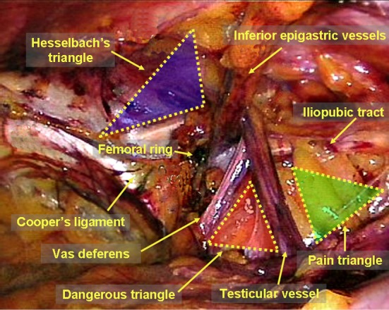 Anatomical diagram of important landmarks in the extraperitoneal preperitoneal space for laparoscopic hernia repair