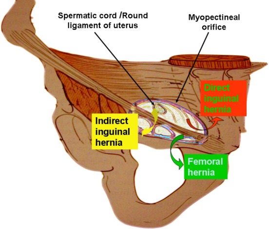 Diagram of the myopectineal orifice showing the inguinal and femoral hernia sites relative to the iliopubic tract and Cooper ligament
