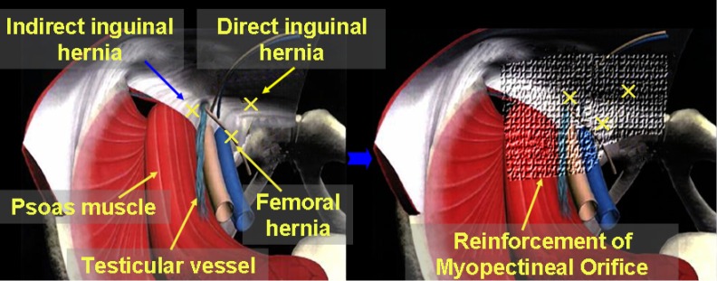 Diagram showing the principle of adult laparoscopic inguinal hernia repair with preperitoneal mesh placement