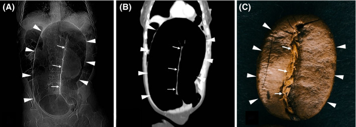 CT scout view and coronal CT image demonstrating the coffee bean sign in sigmoid volvulus