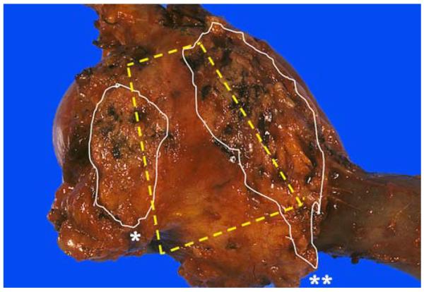 Pancreaticoduodenectomy specimen showing the trapezoid orientation with pancreatic neck margin, uncinate margin, and vascular bed
