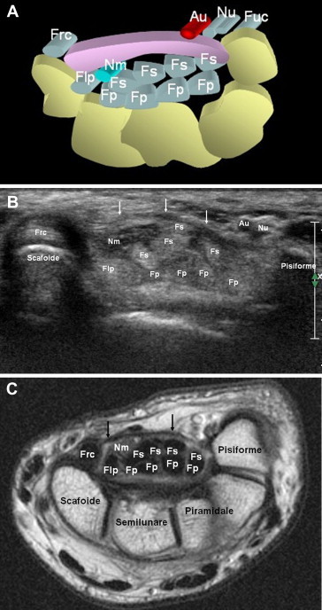 Cross-sectional anatomy of the wrist showing carpal bones, flexor tendons, and median nerve