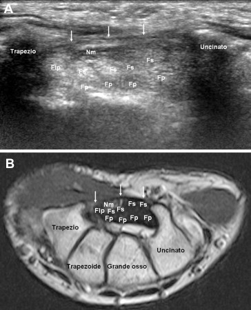 Cross-sectional anatomy of the distal carpal tunnel showing median nerve, flexor tendons, and transverse carpal ligament