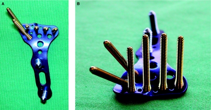 Volar locking plate system for distal radius fracture fixation showing fixed-angle screw placement