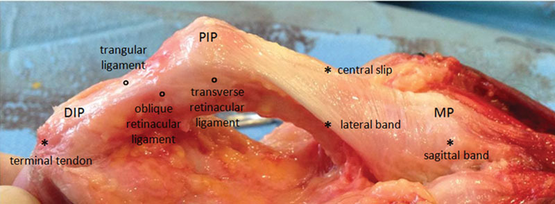 Extensor tendon apparatus of the finger showing central slip, lateral bands, and terminal tendon insertions