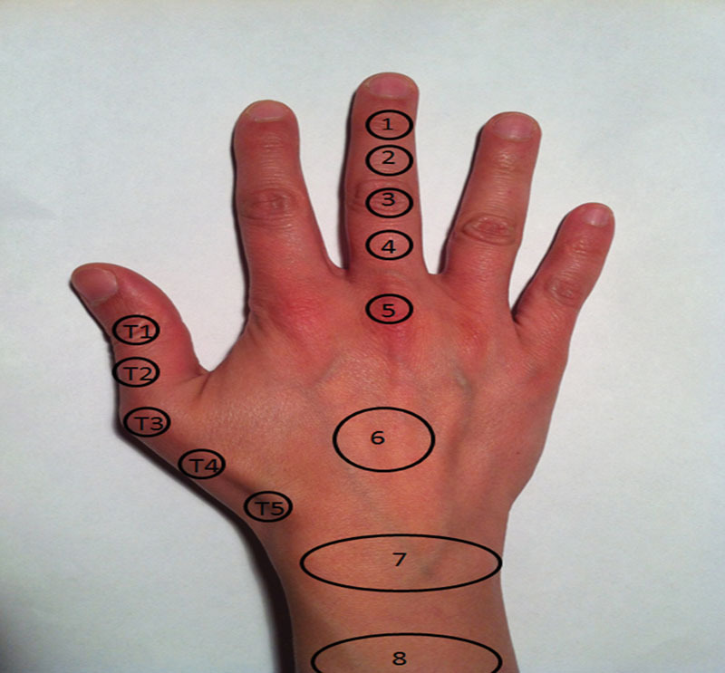 Extensor tendon zones I through IX according to Kleinert and Verdan classification