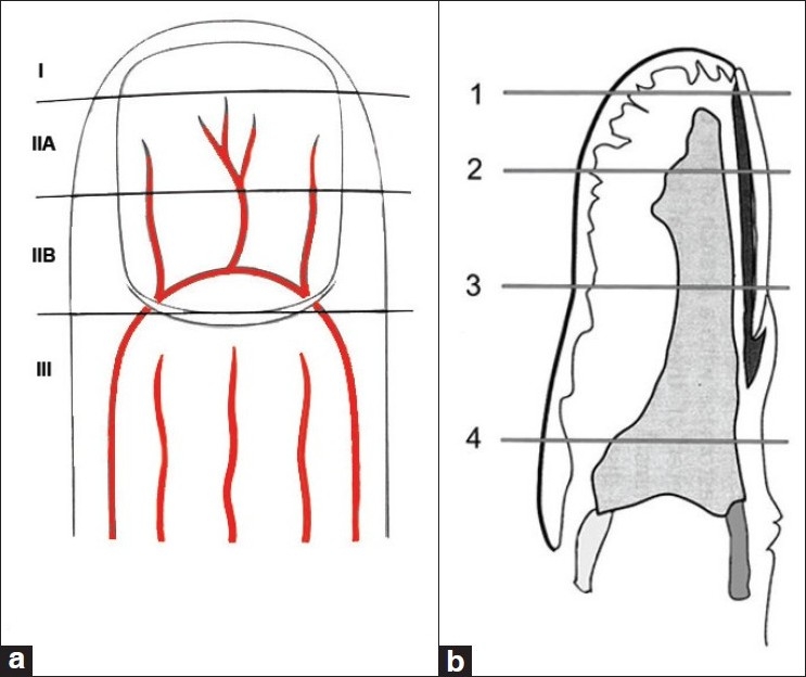 Classification diagram of fingertip amputations showing zones I through IV with arterial and venous anatomy