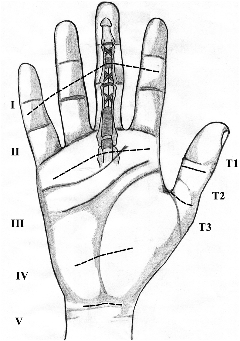 Flexor tendon zones I through V of the hand and thumb zones TI through TV