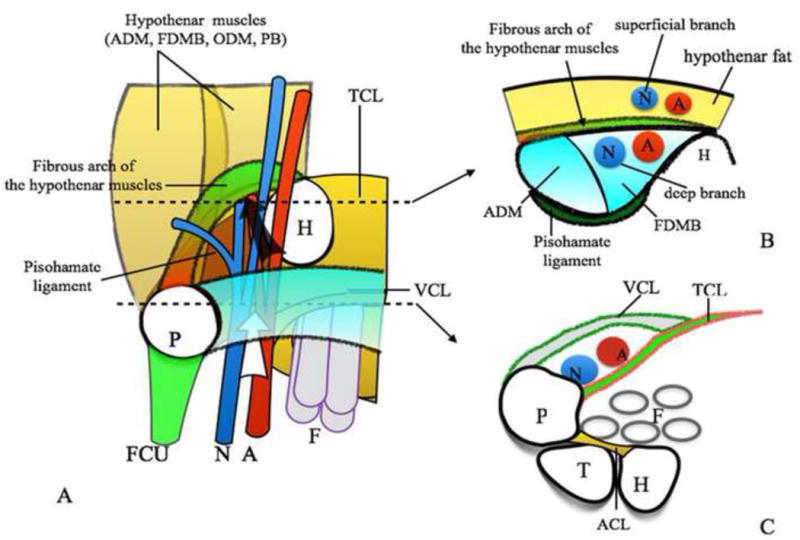 Anatomy of Guyon canal showing ulnar nerve bifurcation into deep motor and superficial sensory branches with three compression zones