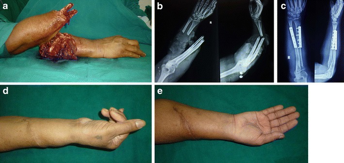 Clinical photograph demonstrating hand assessment following microsurgical intervention with post-operative monitoring