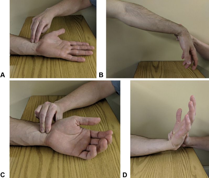 Clinical demonstration of provocative tests including Phalen wrist flexion test and Durkan compression test for carpal tunnel syndrome