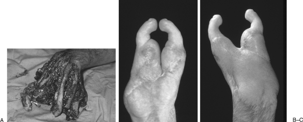 Clinical photograph showing hand anatomy relevant to metacarpal fracture assessment and surgical planning