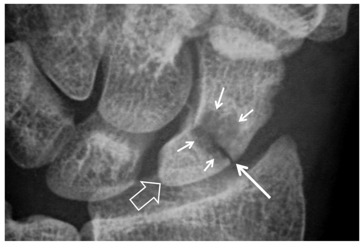 Radiograph showing scaphoid fracture nonunion with sclerosis and pseudarthrosis