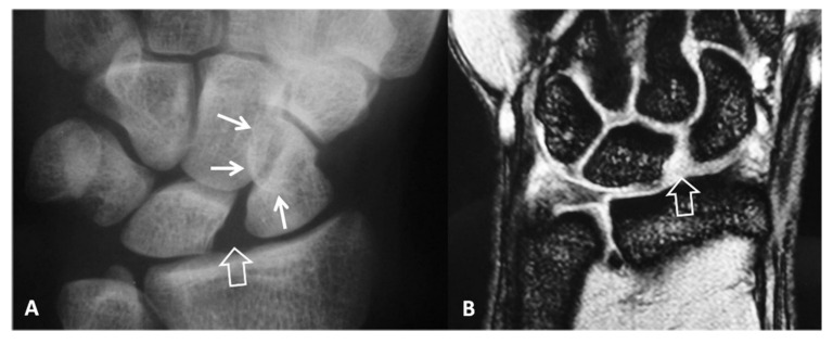 Posteroanterior radiograph showing scapholunate widening (Terry Thomas sign) with scapholunate dissociation
