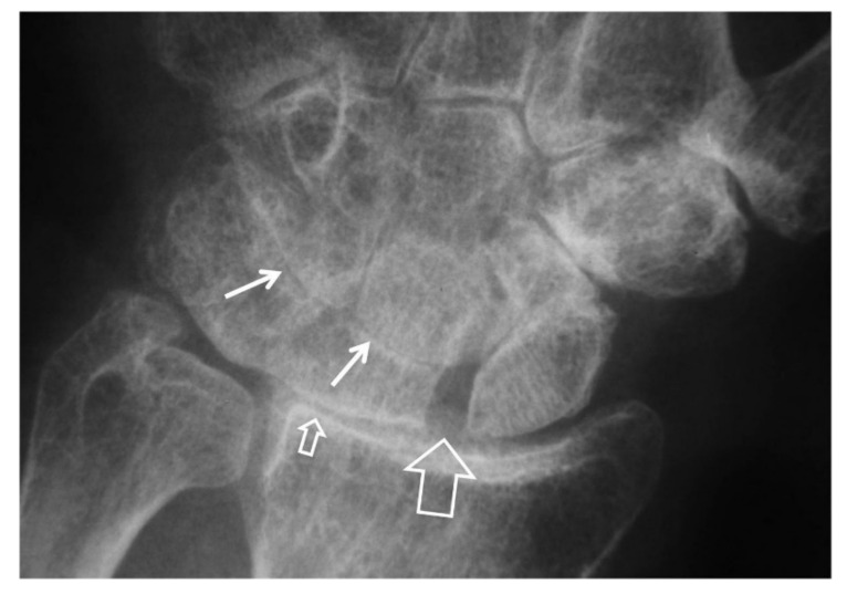 Radiograph demonstrating SLAC wrist with scapholunate diastasis and progressive degenerative changes