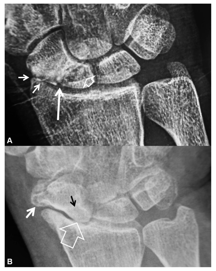PA radiographs showing SNAC wrist stages I and II with progressive radioscaphoid arthritis