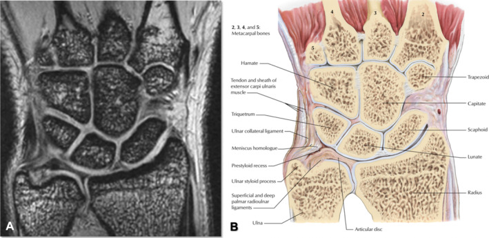 Coronal MRI and anatomical illustration of the TFCC showing articular disc and radioulnar ligaments
