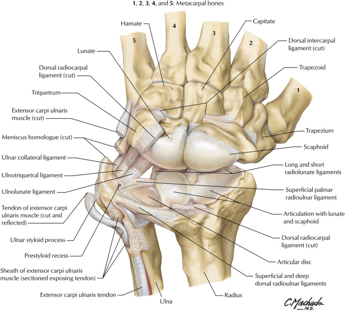 Anatomical illustration of the triangular fibrocartilage complex showing articular disc, radioulnar ligaments, and ulnocarpal ligaments