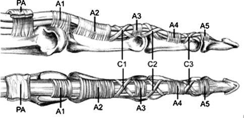 Anatomical diagram of the A1 pulley and flexor tendon sheath showing the pathomechanism of trigger finger