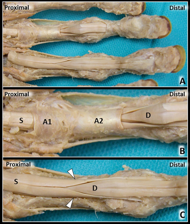 Flexor tendon pulley system showing A1 through A5 annular pulleys and C1 through C3 cruciate pulleys