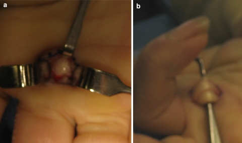 Intraoperative photograph showing tendon and pulley structures during hand surgery under direct visualization
