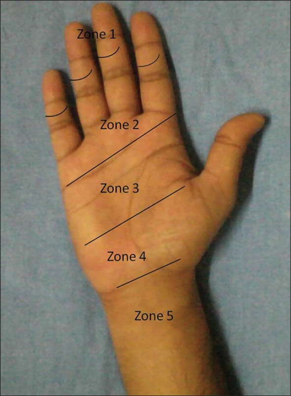 Verdan classification of flexor tendon zones showing Zone II no mans land between A1 pulley and FDS insertion