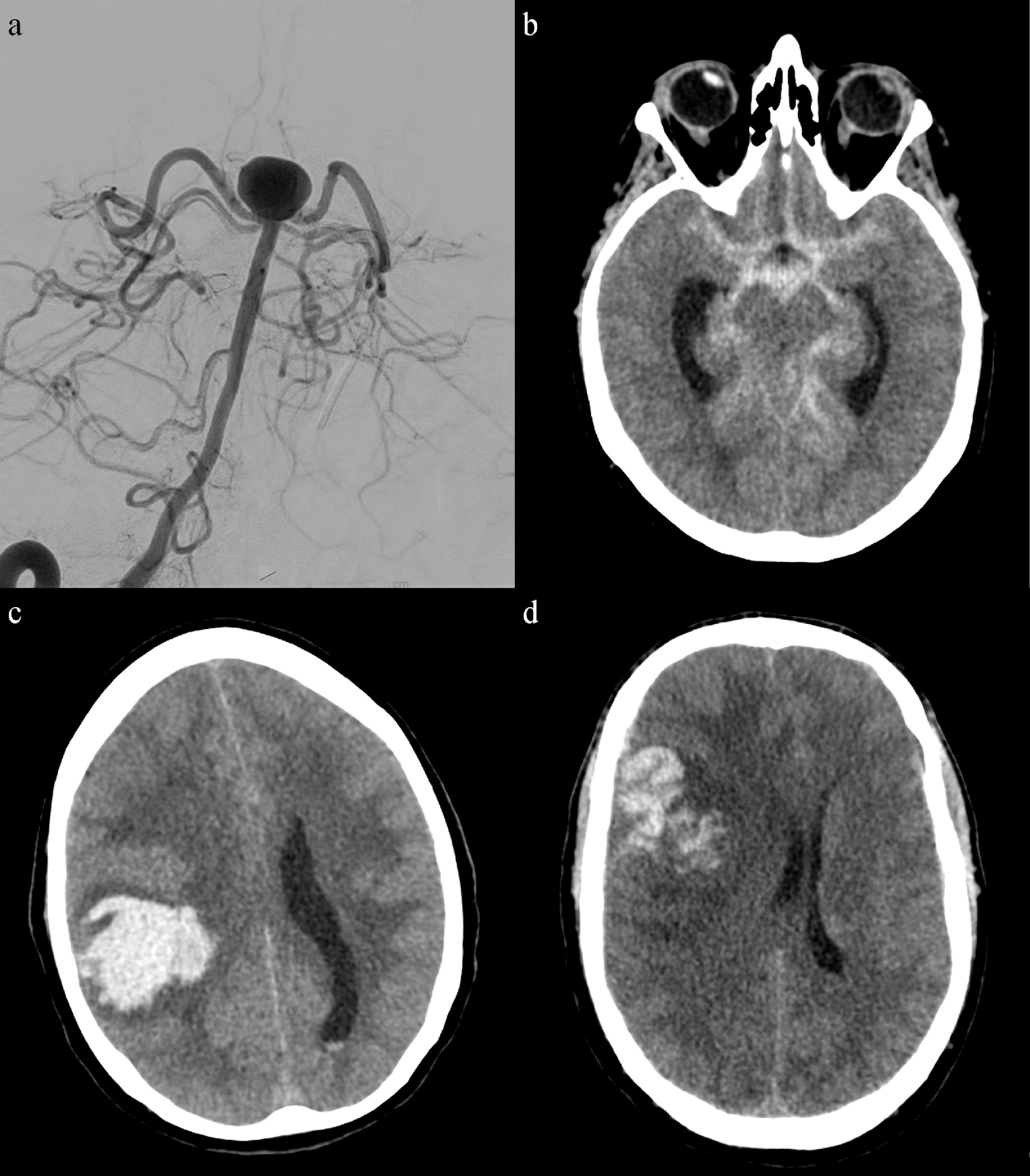 Cerebral angiography and intraoperative images demonstrating intracranial aneurysm before and after microsurgical clipping
