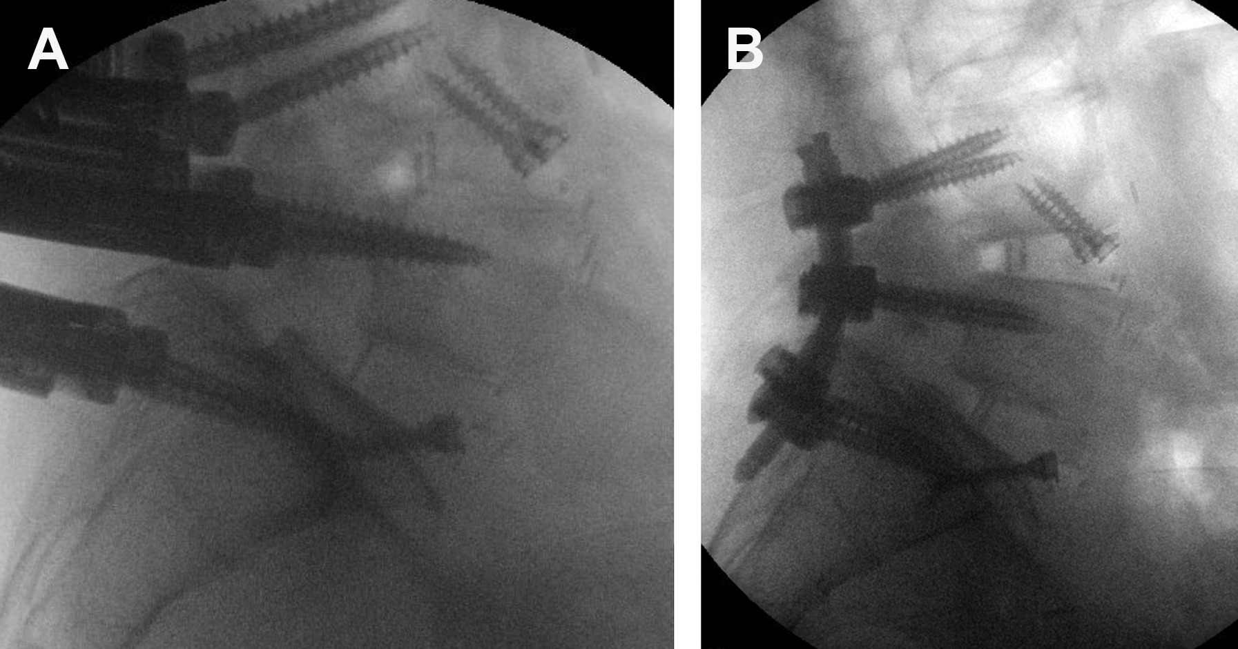 MRI showing a cavernous malformation with characteristic popcorn appearance and hemosiderin ring on T2-weighted and susceptibility-weighted sequences