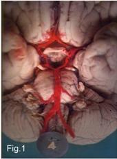 Cadaveric photograph of the circle of Willis showing the anterior and posterior cerebral arteries and communicating arteries at the base of the brain