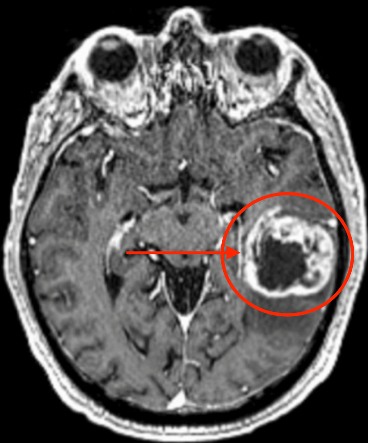 Axial T1-weighted post-gadolinium MRI showing a glioblastoma with irregular ring enhancement and central necrosis