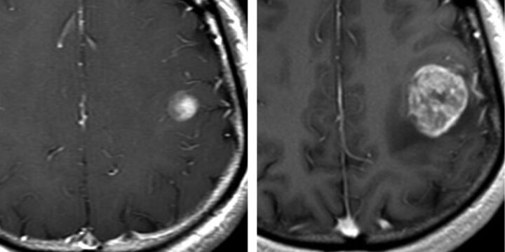 Contrast-enhanced T1-weighted MRI showing early-stage glioblastoma progression over serial imaging