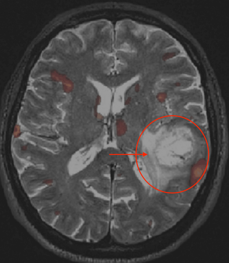 Functional MRI with BOLD imaging during object naming showing eloquent cortex activation adjacent to a brain tumor