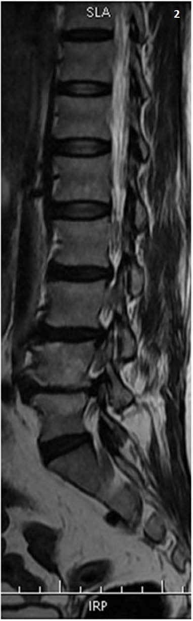 Sagittal and axial MRI of the lumbar spine demonstrating disc herniation compressing the traversing nerve root