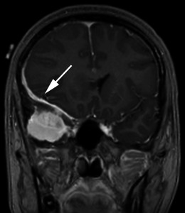 Post-contrast coronal T1-weighted MRI showing a meningioma with dural tail extending along the sphenoid wing causing subfalcine herniation