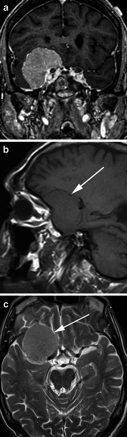 Post-contrast coronal T1-weighted MRI showing a well-circumscribed homogeneously enhancing meningioma with broad dural attachment and dural tail sign