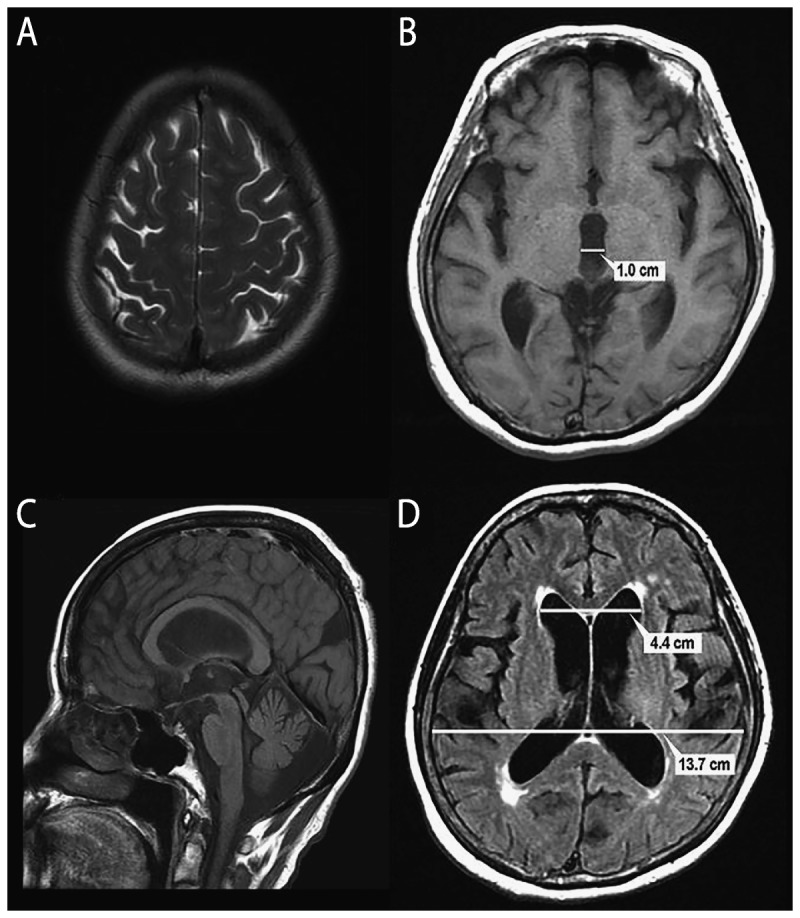 Axial and coronal MRI showing ventriculomegaly disproportionate to sulcal atrophy in normal pressure hydrocephalus