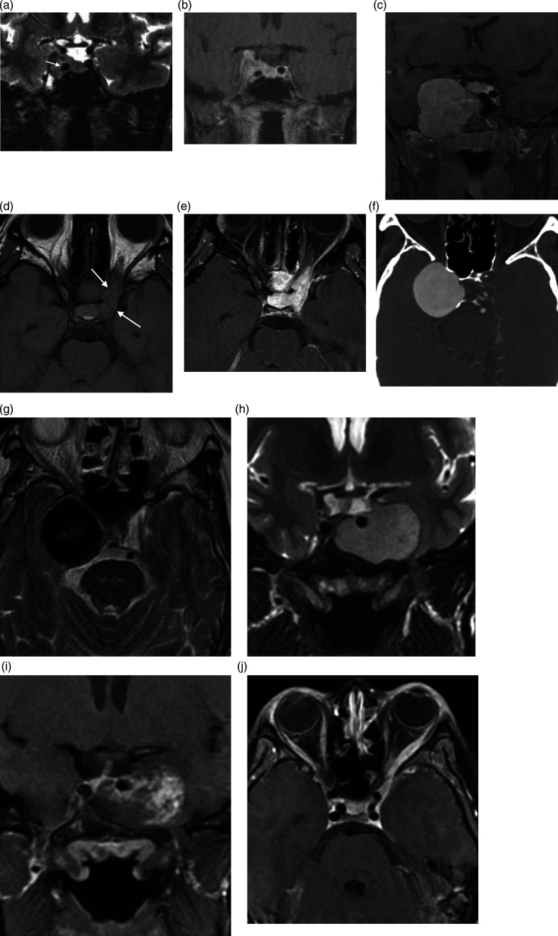 Detailed anatomical illustration of the parasellar region showing the pituitary gland, cavernous sinus, and surrounding neurovascular structures