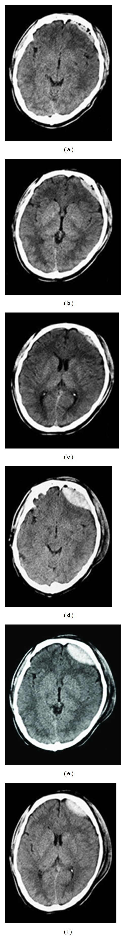 Serial CT scans showing progressive expansion of a traumatic epidural hematoma over time requiring surgical intervention